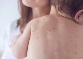 Situation under control after measles outbreak in Kupwara village, says senior doctor