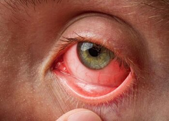 ‘Eye flu’ cases rise to over 17,000 in J&K