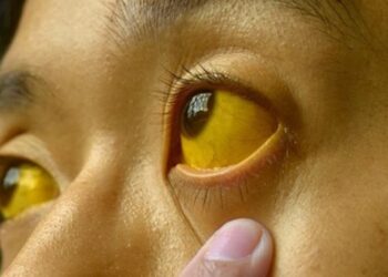 Jaundice outbreak hits Kulgam village, 9 test positive