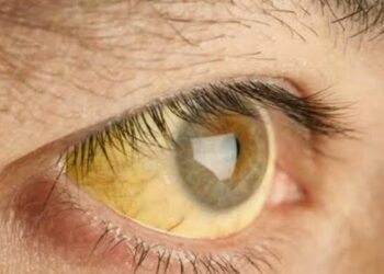 27 test positive for jaundice in Anantnag village
