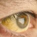 27 test positive for jaundice in Anantnag village
