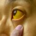 Jaundice in Qazigund: Situation under control, no need to panic: BMO