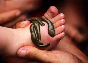 Leech therapy thrives in Kashmir despite modern medical advances